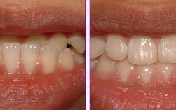 地包天正畸前后照片对比，效果真的明显吗？