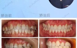 反合牙齿矫正过程图片能展示哪些矫正步骤和效果？