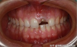 门牙两个拔掉 待种牙