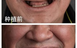 在广州种牙好不好