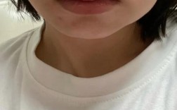 种牙之后脸肿了