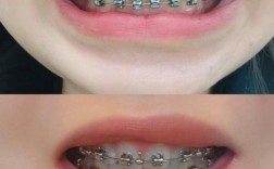 矫正完牙齿后牙齿为什么会变软？需要担心吗？