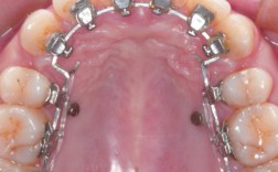 口腔正畸牵引图片能直观展示哪些牵引细节？