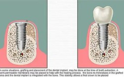 种植牙不需要植骨
