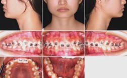 正畸安氏分类病例中，不同类型的临床特征与矫治策略差异？