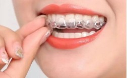 矫正牙齿后为何要戴隐形牙套？佩戴时长与作用是关键？