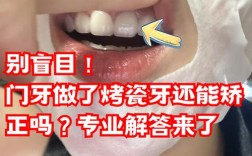 烤瓷牙可不可以正畸