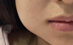 种牙后脸部肿胀