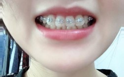 福州矫正牙齿贝臣权威