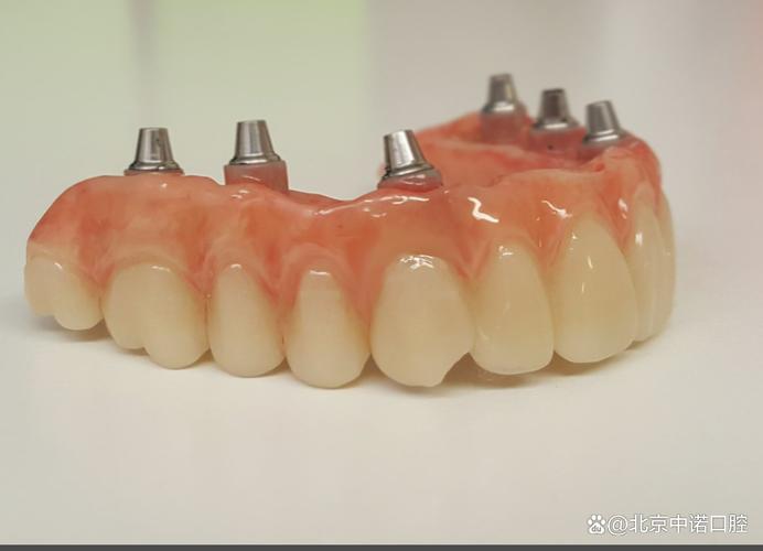 即刻种植牙视频揭秘，种植过程是怎样的？效果真实吗？优势在哪？-图1