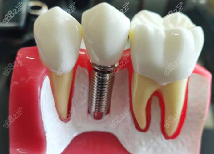 太原哪里可以做种植牙?正规医院和诊所有哪些推荐?-图1 太原哪里可以做种植牙?正规医院和诊所有哪些推荐?-图1