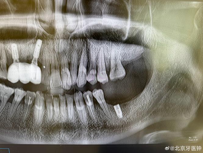 种植牙基台掉了被吃下去，会有什么危险？如何处理？-图2