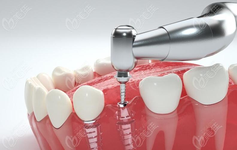 二代种植牙效果如何?是否适合所有人?-图1 二代种植牙效果如何?是否适合所有人?-图1