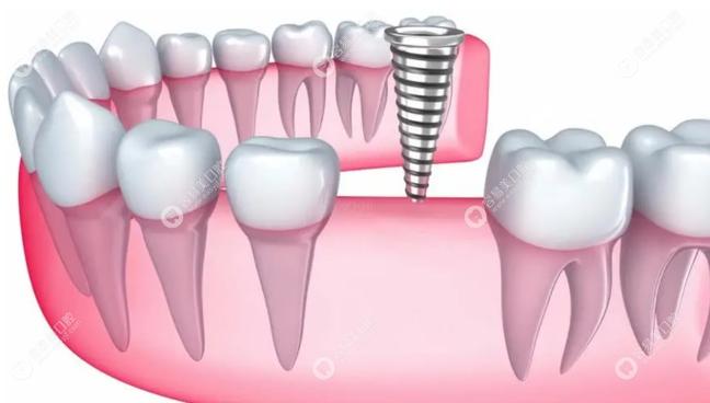 二代种植牙效果如何?是否适合所有人?-图2 二代种植牙效果如何?是否适合所有人?-图2