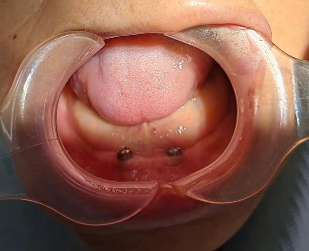 康贝佳口腔种植全口牙多少钱？效果真的好吗？-图1