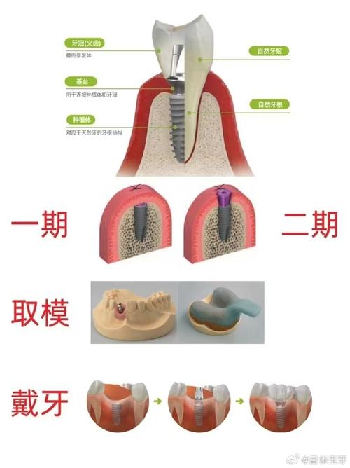 种植牙能取下来吗？-图3