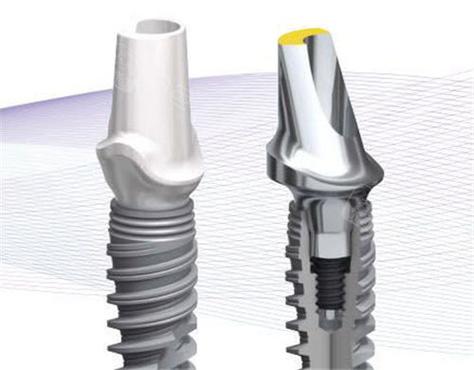 诺贝尔种植牙的特点-图1