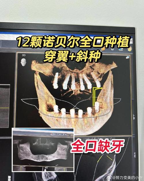 种植牙歪斜是什么原因导致的？该如何处理和预防？-图2