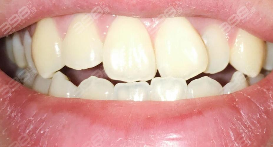 种植牙歪斜是什么原因导致的？该如何处理和预防？-图3