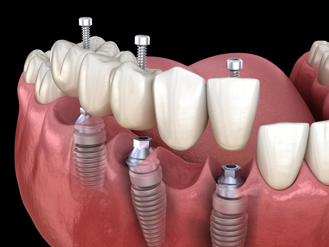 微创种植牙图片大全能展示哪些关键信息？-图1