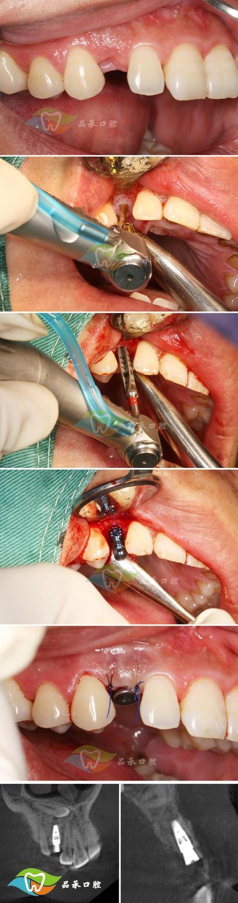 微创种植牙图片大全能展示哪些关键信息？-图2