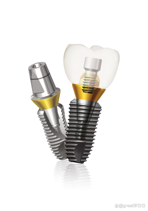 诺贝尔种植牙为何要一万?价格是否虚高?-图3 诺贝尔种植牙为何要一万?价格是否虚高?-图3