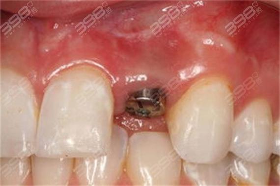 诺贝尔种植牙为何要一万?价格是否虚高?-图1 诺贝尔种植牙为何要一万?价格是否虚高?-图1