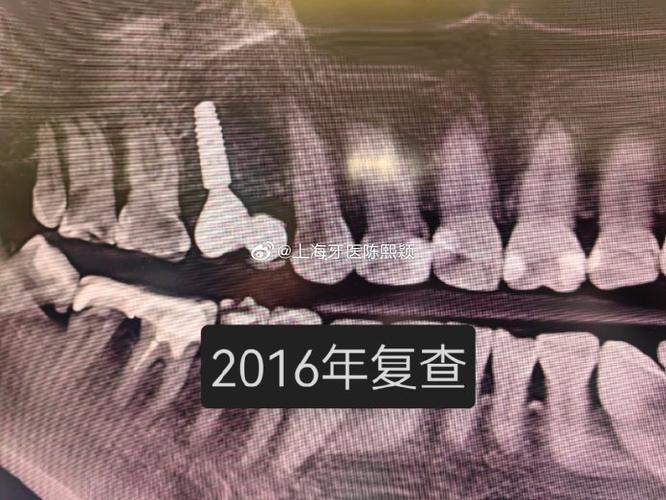 上海最早开展种植牙手术的具体时间是什么时候？-图2