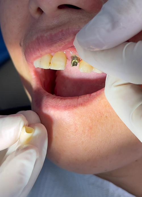 真实的种植牙感觉怎样?能和真牙一样好用吗?-图1 真实的种植牙感觉怎样?能和真牙一样好用吗?-图1