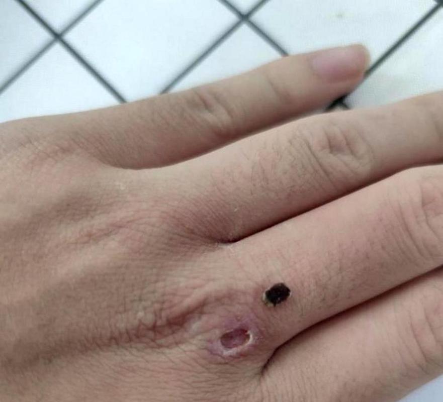 种植牙后有血痂正常吗？需注意哪些护理事项？-图2