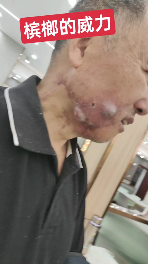 种植牙后引起口腔癌-图1