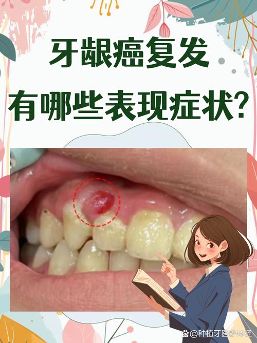 种植牙后引起口腔癌-图2