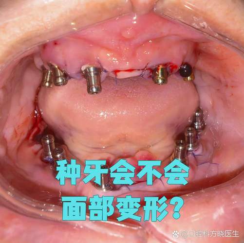 种植牙会影响脸型吗-图2
