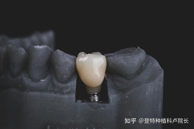 西北种植牙技术如何？选医院要注意哪些关键问题？-图2