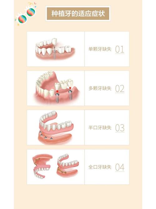 种植牙怎么接诊-图2 种植牙怎么接诊-图2