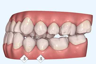 虎牙拔除后能否种植牙？这样做可行吗？有什么影响？-图3
