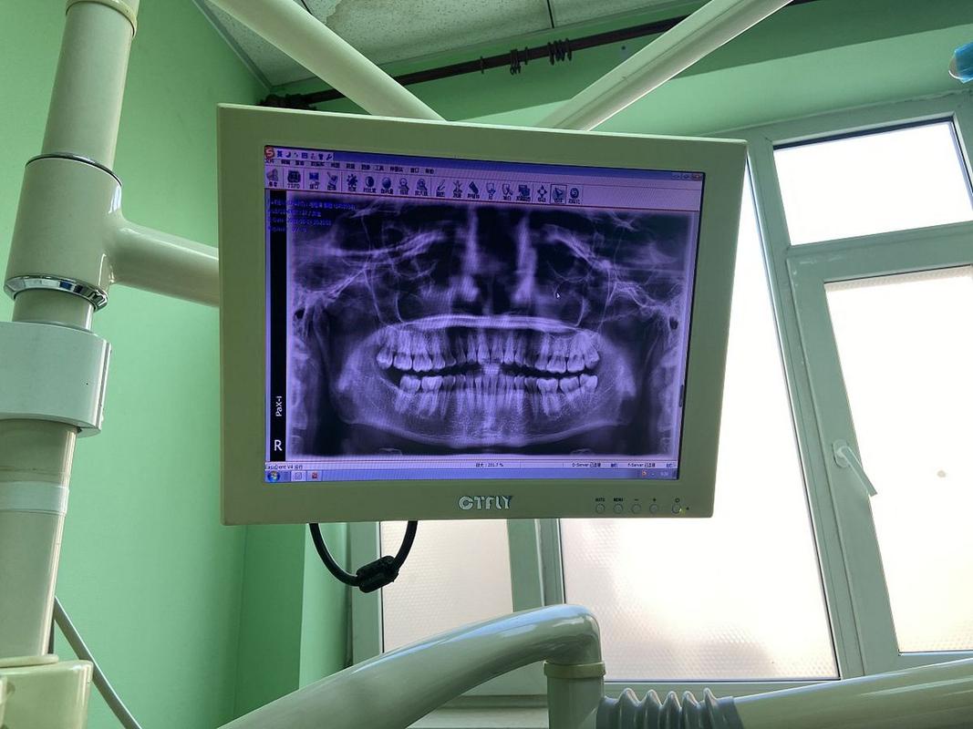 种植牙术前骨量评估为何依赖CT测量？精准数据如何保障种植成功？-图3