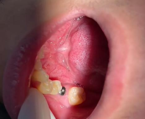 种植牙二期切-图2