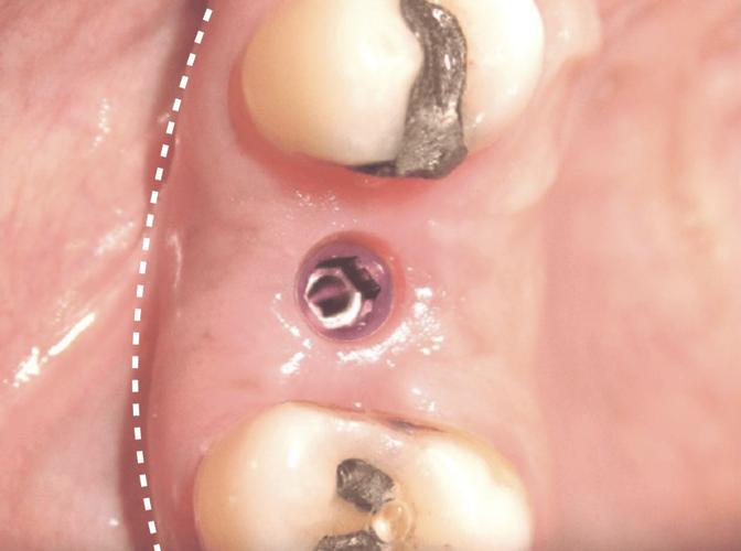 种植牙二期切-图1