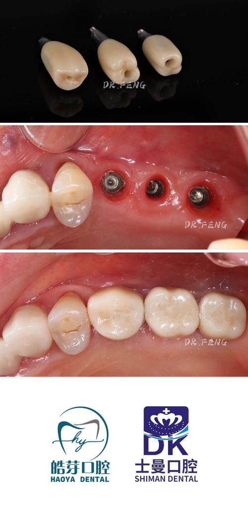 鞍山种植牙价格多少？效果怎么样？医院怎么选才靠谱？要注意什么？-图3