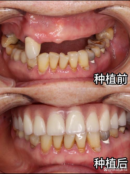 牙齿缺失，种植牙图能告诉我们什么修复信息？-图2