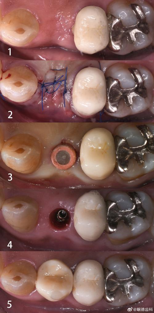 牙齿缺失，种植牙图能告诉我们什么修复信息？-图3
