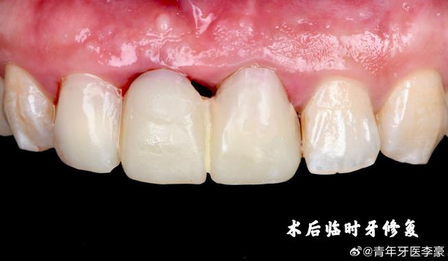牙前区种植修复效果如何？关键技术与注意事项有哪些？-图2