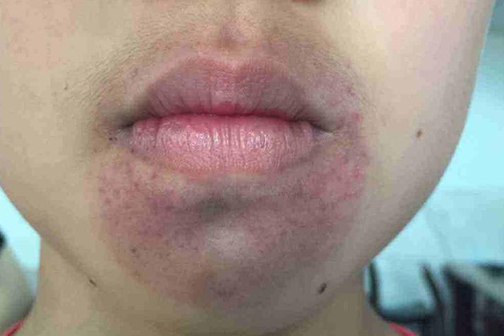 种植牙会导致下巴发紫吗?-图1 种植牙会导致下巴发紫吗?-图1