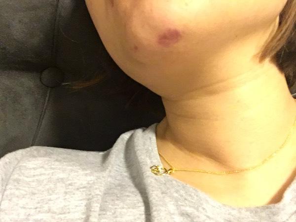 种植牙会导致下巴发紫吗？-图2