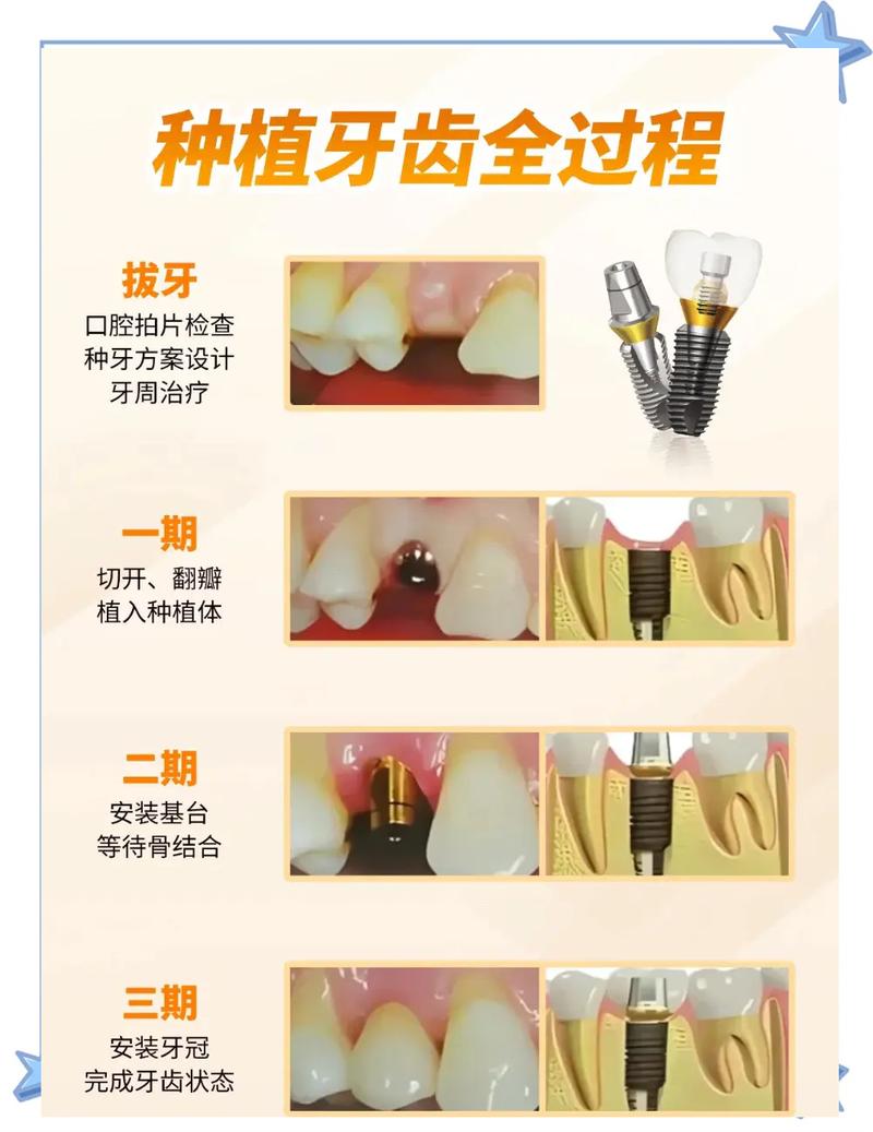 种植牙种植案例越来越多，这背后究竟是什么原因导致的？-图1