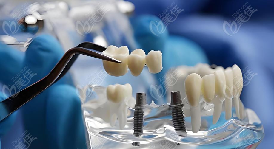 东莞拜博口腔种植牙真实效果咋样？价格透明吗？技术靠谱吗？-图2