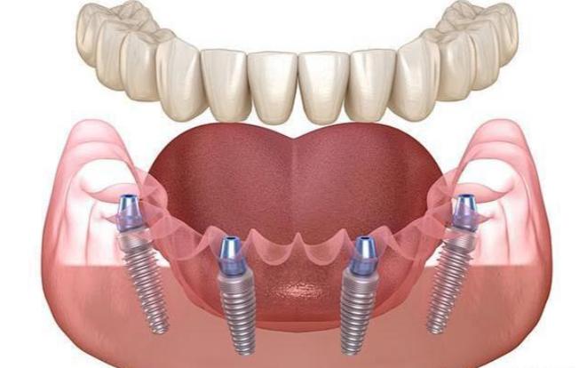 瑞典最久种植牙寿命有多长？技术优势何在？-图2