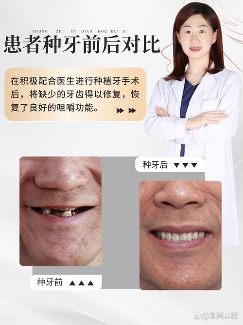 重度牙周炎能种牙吗？需先治好牙周炎吗？-图3