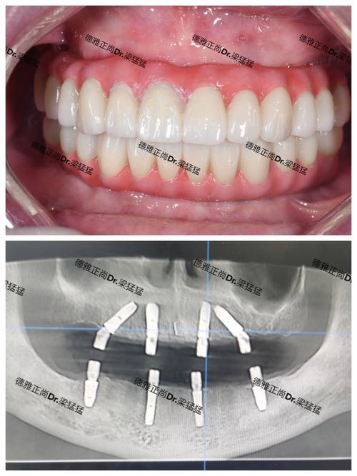 种植牙手术哪家好？如何选择靠谱的种植机构？-图1
